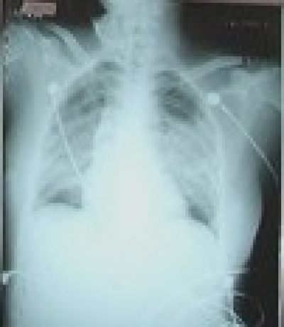 Hình ảnh XQ điển hình của người viêm phổi COVID 19